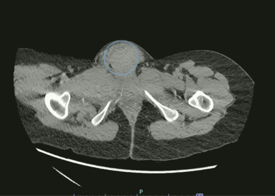 Vulvar Hematoma. CT Axial Annotated. JETem 2024