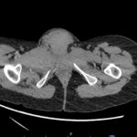 Vulvar Hematoma. CT Axial Unannotated. JETem 2024