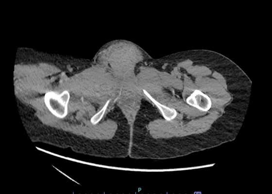 Vulvar Hematoma. CT Axial Unannotated. JETem 2024