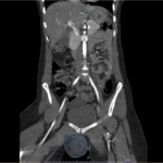 Vulvar Hematoma. CT Coronal Annotated. JETem 2024