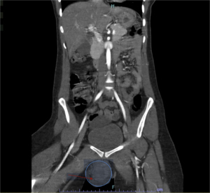 Vulvar Hematoma. CT Coronal Annotated. JETem 2024