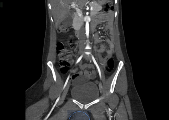 Vulvar Hematoma. CT Coronal Annotated. JETem 2024