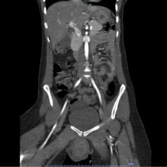 Vulvar Hematoma. CT Coronal Unannotated. JETem 2024