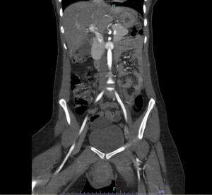 Vulvar Hematoma. CT Coronal Unannotated. JETem 2024