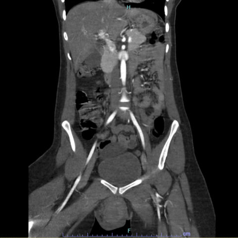 Vulvar Hematoma Healing When To See A Doctor - ck7td2h