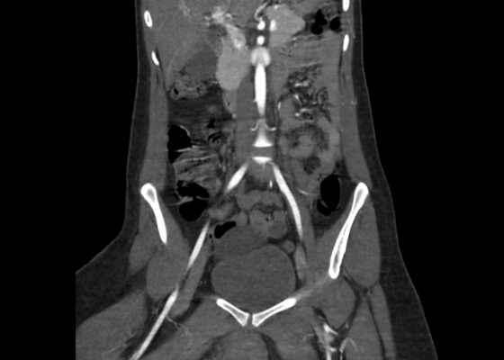 Vulvar Hematoma. CT Coronal Unannotated. JETem 2024