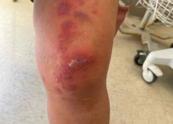 Erythema Multiforme. Knee. JETem 2025