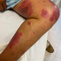 Erythema Multiforme. Medial leg. JETem 2025