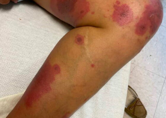 Erythema Multiforme. Medial leg. JETem 2025