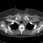 RPA Chest. CT Lateral. Annotated. JETem 2025