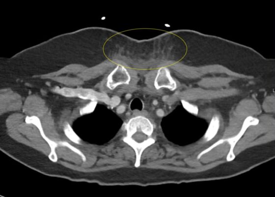 RPA Chest. CT Lateral. Annotated. JETem 2025