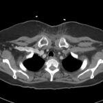 RPA Chest. CT Lateral. Unannotated. JETem 2025