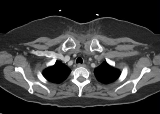 RPA Chest. CT Lateral. Unannotated. JETem 2025