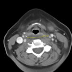 RPA Neck. CT Axial. Annotated. JETem 2025