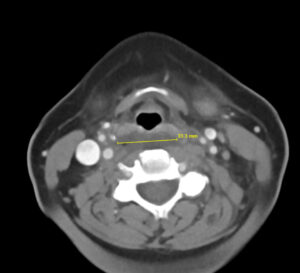 RPA Neck. CT Axial. Annotated. JETem 2025