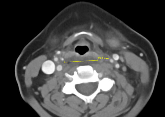 RPA Neck. CT Axial. Annotated. JETem 2025