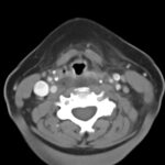 RPA Neck. CT Axial. Unannotated. JETem 2025