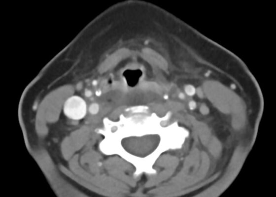 RPA Neck. CT Axial. Unannotated. JETem 2025