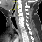 RPA Neck. CT Lateral. Annotated. JETem 2025