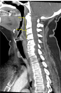 RPA Neck. CT Lateral. Annotated. JETem 2025