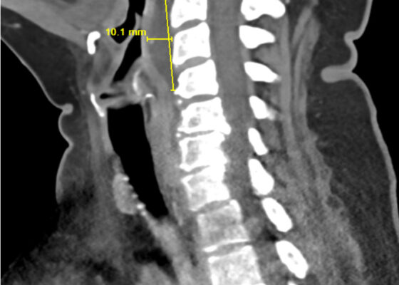 RPA Neck. CT Lateral. Annotated. JETem 2025