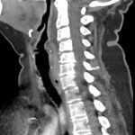 RPA Neck. CT Lateral. Unannotated. JETem 2025