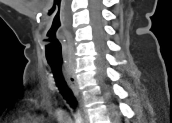 RPA Neck. CT Lateral. Unannotated. JETem 2025