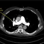 Wolff A et al. Right atrial thrombosis. CT axial 1