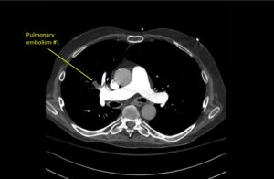 Wolff A et al. Right atrial thrombosis. CT axial 1