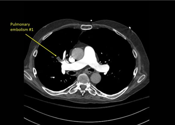 Wolff A et al. Right atrial thrombosis. CT axial 1