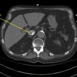 Wolff A et al. Right atrial thrombosis. CT axial IVC 1