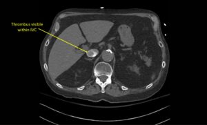 Wolff A et al. Right atrial thrombosis. CT axial IVC 1