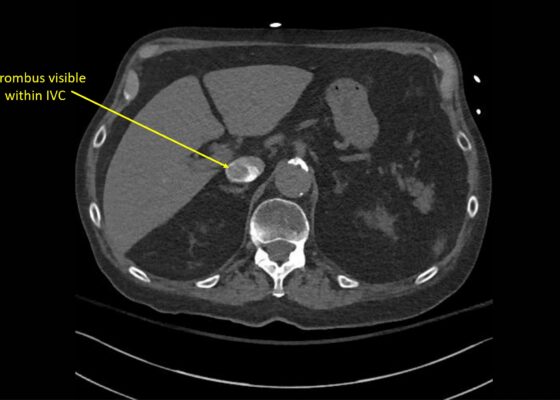 Wolff A et al. Right atrial thrombosis. CT axial IVC 1