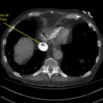 Wolff A et al. Right atrial thrombosis. CT axial IVC 2