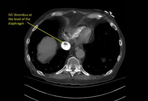 Wolff A et al. Right atrial thrombosis. CT axial IVC 2