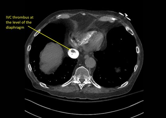 Wolff A et al. Right atrial thrombosis. CT axial IVC 2