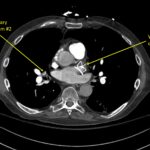 Wolff A et al. Right atrial thrombosis. CT axial PE 2