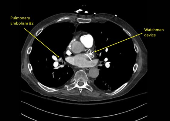 Wolff A et al. Right atrial thrombosis. CT axial PE 2