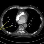 Wolff A et al. Right atrial thrombosis. CT axial PE 3