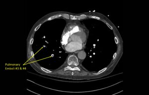 Wolff A et al. Right atrial thrombosis. CT axial PE 3
