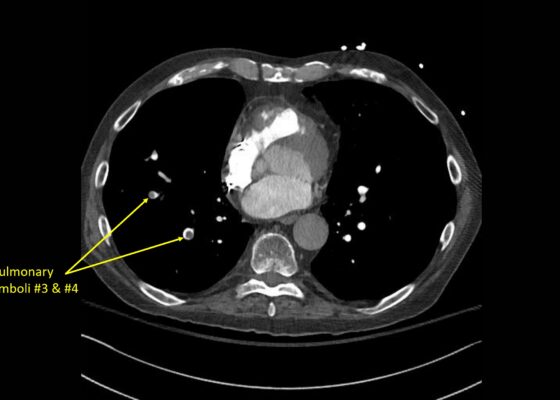 Wolff A et al. Right atrial thrombosis. CT axial PE 3