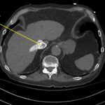 Wolff A et al. Right atrial thrombosis. CT axial juncture of hepatic vein