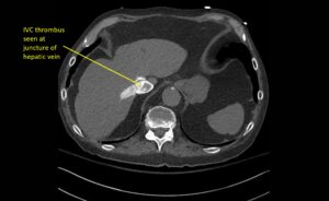 Wolff A et al. Right atrial thrombosis. CT axial juncture of hepatic vein