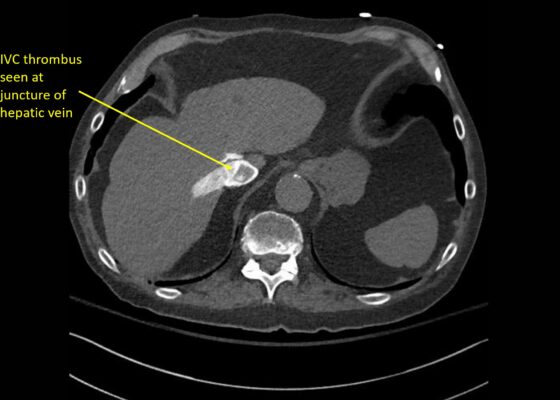 Wolff A et al. Right atrial thrombosis. CT axial juncture of hepatic vein