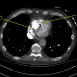 Wolff A et al. Right atrial thrombosis. CT axial right atrium