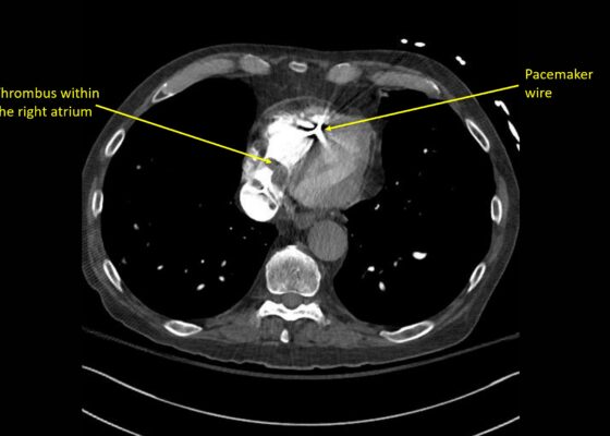 Wolff A et al. Right atrial thrombosis. CT axial right atrium