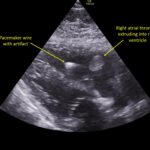 Wolff A et al. Right atrial thrombosis. Parasternal long US 1 annotated