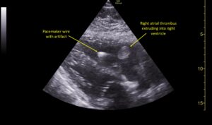 Wolff A et al. Right atrial thrombosis. Parasternal long US 1 annotated
