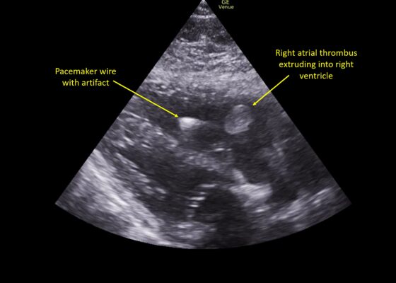 Wolff A et al. Right atrial thrombosis. Parasternal long US 1 annotated