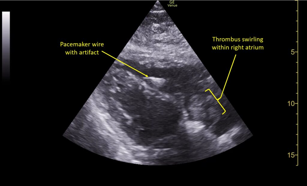 A Case Report of Right Atrial Thrombosis Complicated by Multiple ...